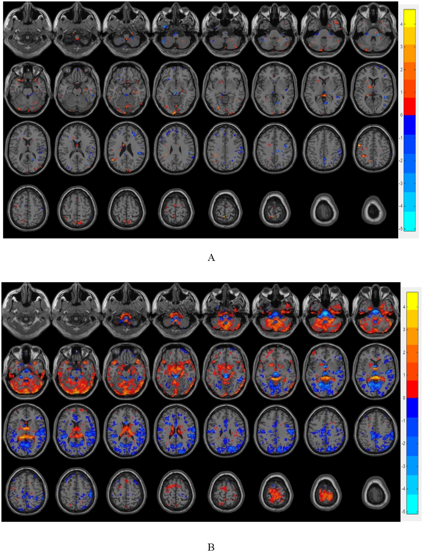 Brain fMRI scans showing axial slices at different levels in two panels, labeled A and B. Each panel has color-coded overlays indicating different levels of brain activity, with blue and red highlights. A vertical color bar on the right of each panel shows a scale from -5 to 4, indicating the strength of activity. The slices progress from lower to upper regions of the brain.