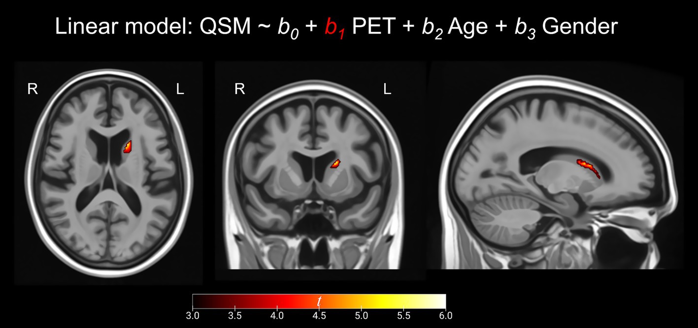 Three MRI brain scans show highlighted regions in red and yellow, indicating areas of interest in a linear model analyzing QSM with PET, age, and gender as variables. A color bar below represents intensity from three to six.
