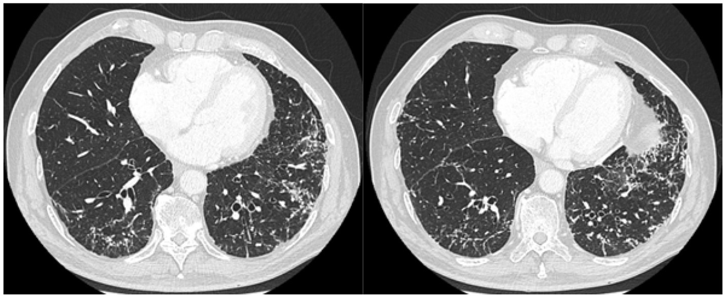 CT scan images of lungs showing cross-sectional views. The left image displays lung tissue with a clear pattern, while the right image shows more dense areas, suggesting possible abnormalities. Both images include the heart and chest sections for anatomical reference.
