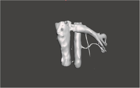 3D-rendered anatomical structure with intertwined tubular forms, resembling blood vessels or nerves, in a light gray color on a dark background.