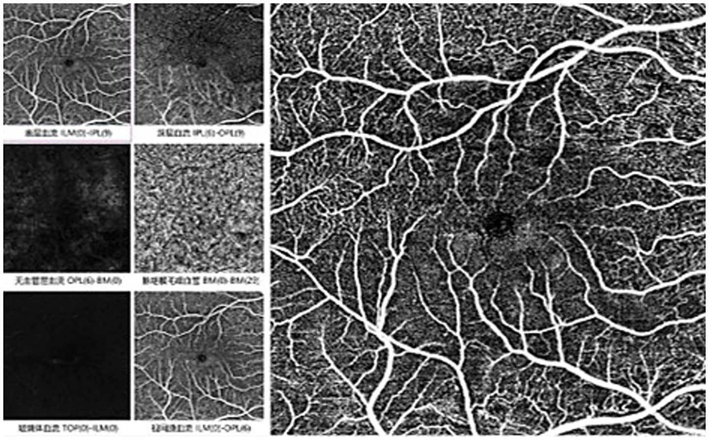 Black and white medical images depicting retinal vascular structures. The left column displays six smaller images with different grayscale patterns, labeled in Chinese. The right side features a large, detailed image of branching blood vessels originating from a central point, highlighting intricate eye anatomy.