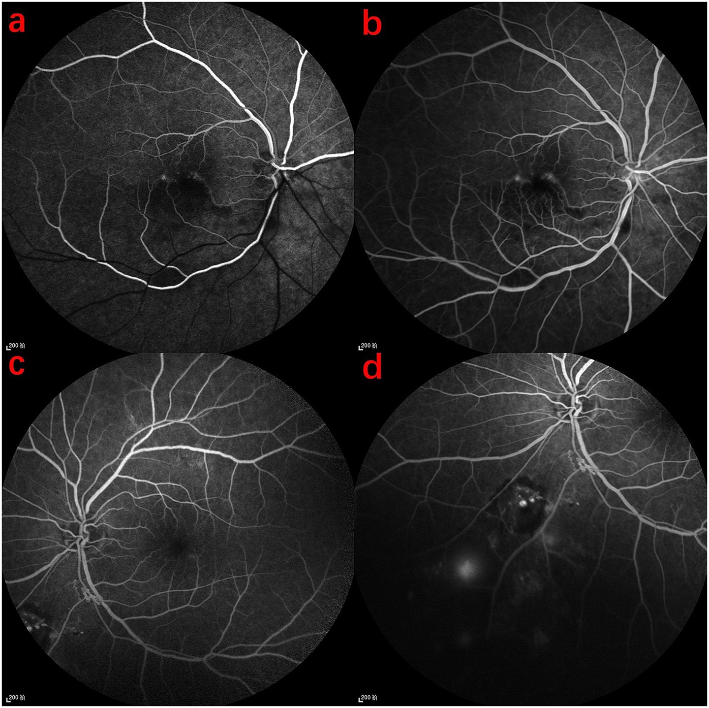 Four-panel image of retinal angiography. Panel a shows early filling of retinal blood vessels. Panel b displays increased vessel filling. Panel c shows further vascular enhancement. Panel d reveals late-stage with visible lesions and leakage.