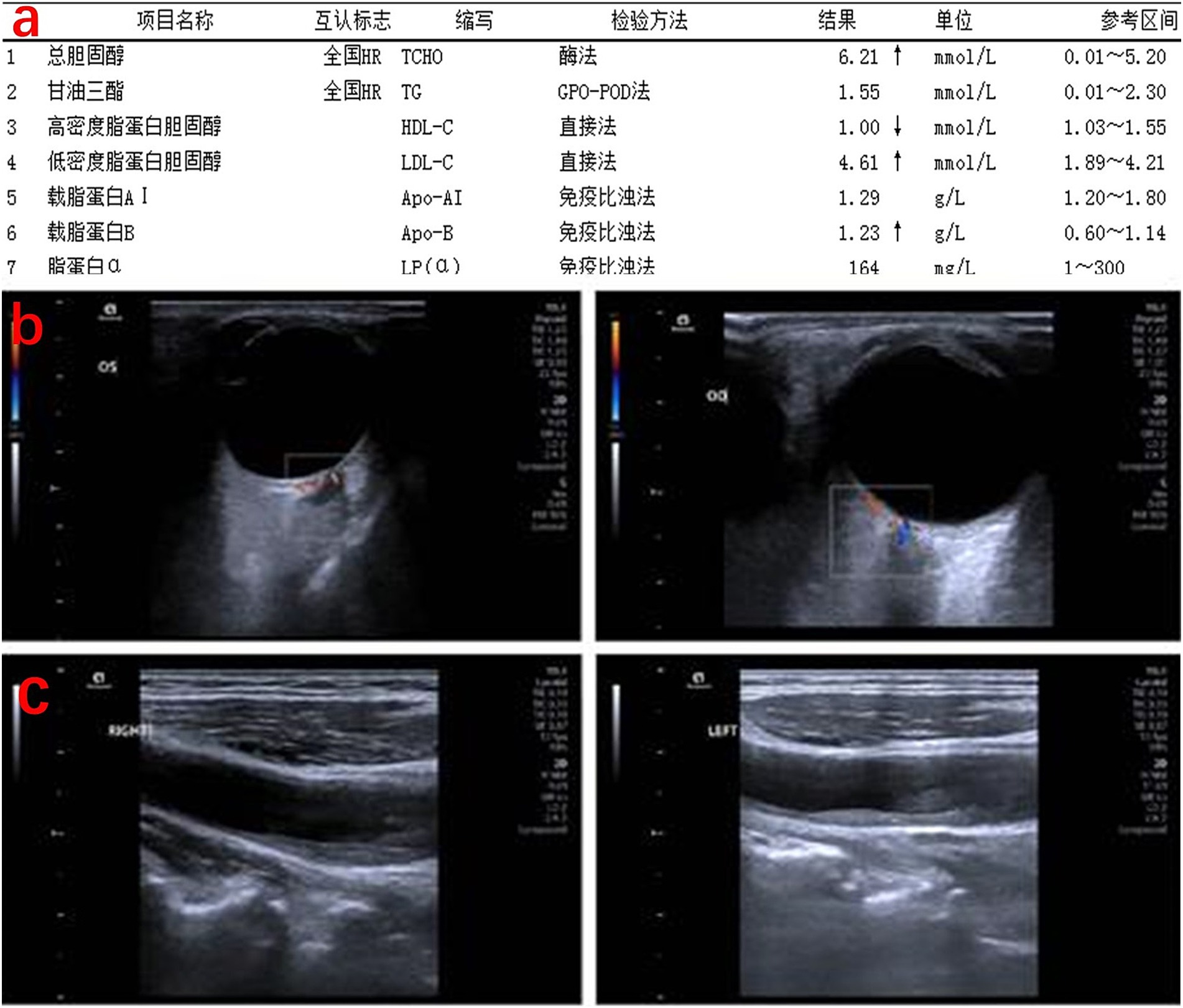 Table with blood test results showing various lipid and cholesterol measurements with their respective methods and reference ranges. Below, four ultrasound images labeled b and c depict internal body structures in grayscale, each showing different views or sections.
