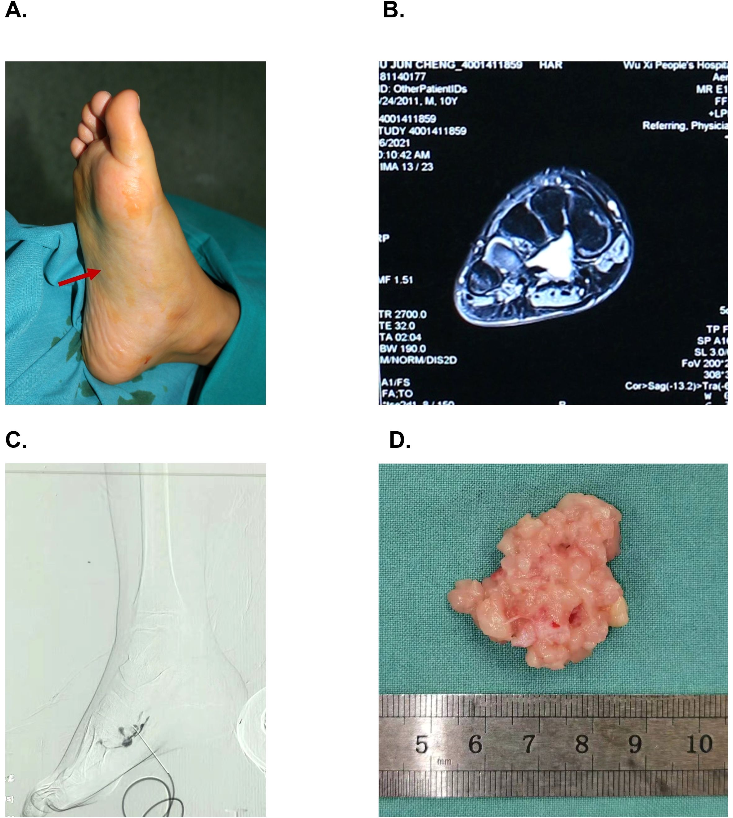 A. Foot with a visible swelling on the side, indicated by a red arrow. B. MRI scan showing a cross-section of the foot, highlighting internal structures. C. X-ray image of the foot with a wire inserted near the heel area. D. Excised tissue sample on a blue cloth next to a ruler, measuring about 5 centimeters.