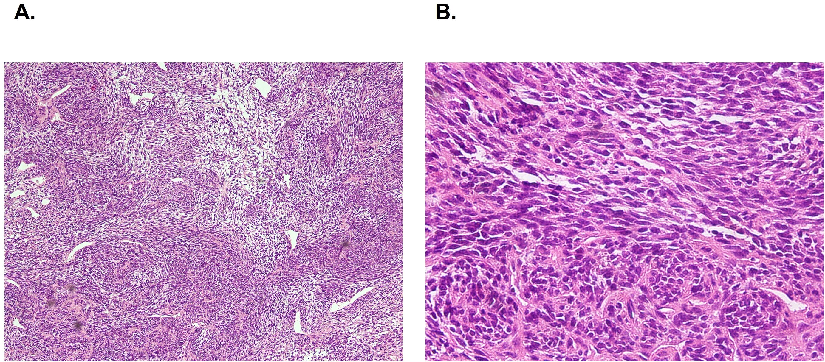 Panel A shows a histological image with densely packed spindle-shaped cells in a haphazard arrangement. Panel B displays a higher magnification of similar spindle-shaped cells arranged more compactly with visible nuclei. The staining appears pink and purple, indicating cellular and matrix components.