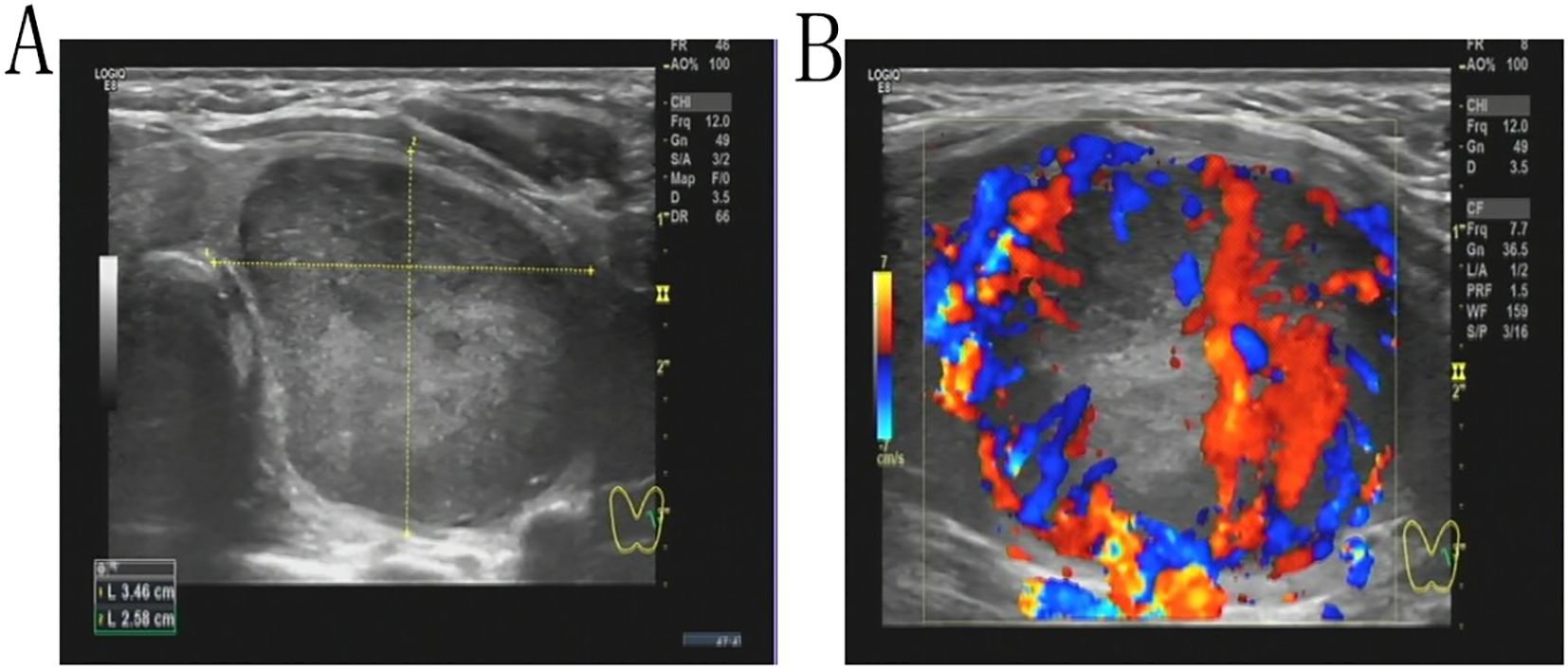 Panels A and B display ultrasound images. Panel A shows a grayscale ultrasound with a circular structure and measurement lines indicating sizes. Panel B is a color Doppler ultrasound with red and blue areas indicating blood flow within the same structure.