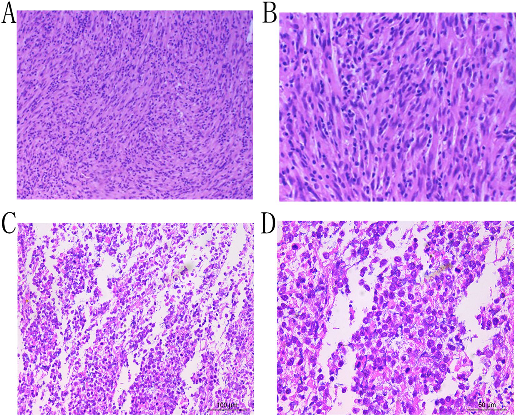 Microscopic images of tissue sections are labeled A, B, C, and D. Images A and B show dense spindle-shaped cells with a uniform arrangement. Images C and D display a less organized structure with round, densely packed cells. Sections are stained in shades of purple and pink.