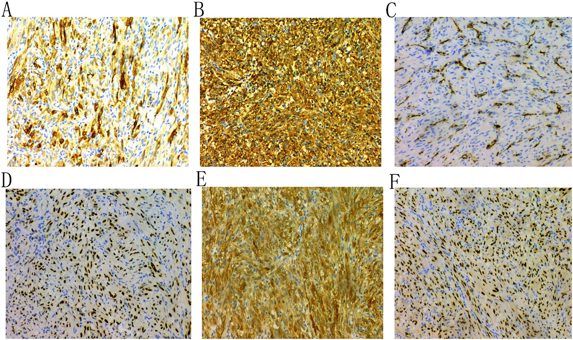 Panel of six images labeled A to F, showing microscopy images of tissue samples. Panels A, B, and E display dense staining with brownish coloration, indicating high presence of certain proteins or markers. Panels C, D, and F exhibit lighter or more dispersed staining, suggesting lower protein presence. Background tissue appears in shades of blue, indicating cellular context. Each image highlights different staining patterns and intensity variations for comparative analysis.