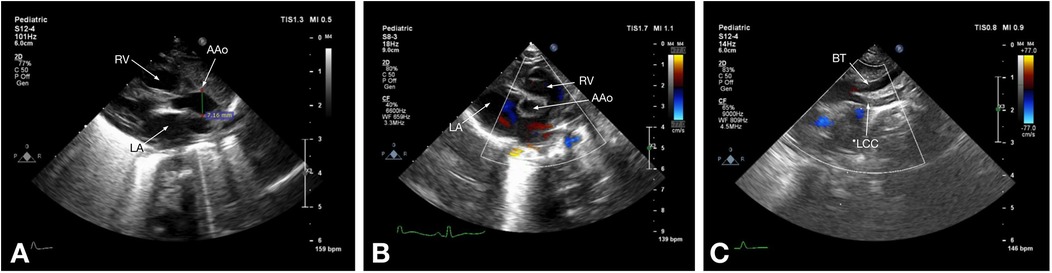 Three pediatric echocardiographic images labeled A, B, and C. Image A shows the heart’s right ventricle (RV), left atrium (LA), and ascending aorta (AAo) with a dimension measurement. Image B highlights the left atrium (LA) with color flow mapping. Image C displays the brachiocephalic trunk (BT) and left common carotid (LCC) artery, with color Doppler illustrating blood flow direction.