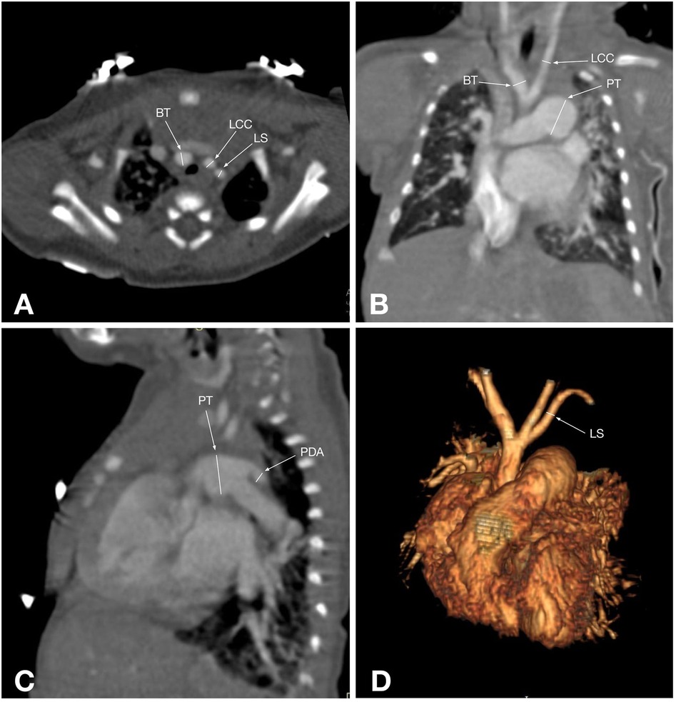 Cross-sectional and 3D images of the chest, labeled A to D. Panel A shows a transverse cross-section highlighting the brachiocephalic trunk (BT), left common carotid artery (LCC), and left subclavian artery (LS). Panel B presents a coronal cross-section with the same labels, including the pulmonary trunk (PT). Panel C offers a sagittal view, focusing on the PT and patent ductus arteriosus (PDA). Panel D features a 3D reconstruction with a focus on the LS.