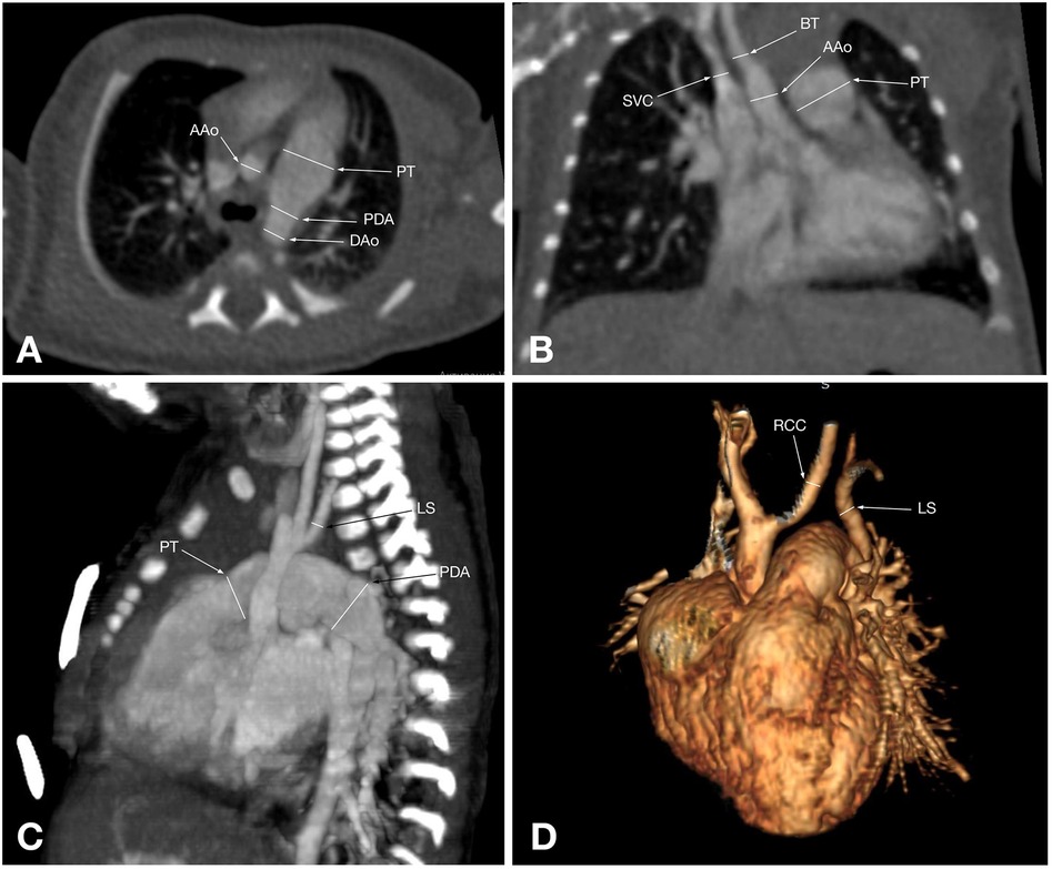 CT images of the heart showing various anatomical structures. Image A displays the ascending aorta (AAo), pulmonary trunk (PT), patent ductus arteriosus (PDA), and descending aorta (DAo) in a cross-sectional view. Image B presents the AAo, PT, superior vena cava (SVC), and brachiocephalic trunk (BT) from a frontal perspective. Image C shows a side view highlighting the PT, PDA, and left subclavian artery (LS). Image D is a 3D reconstruction of the heart, labeling the right common carotid artery (RCC) and LS.