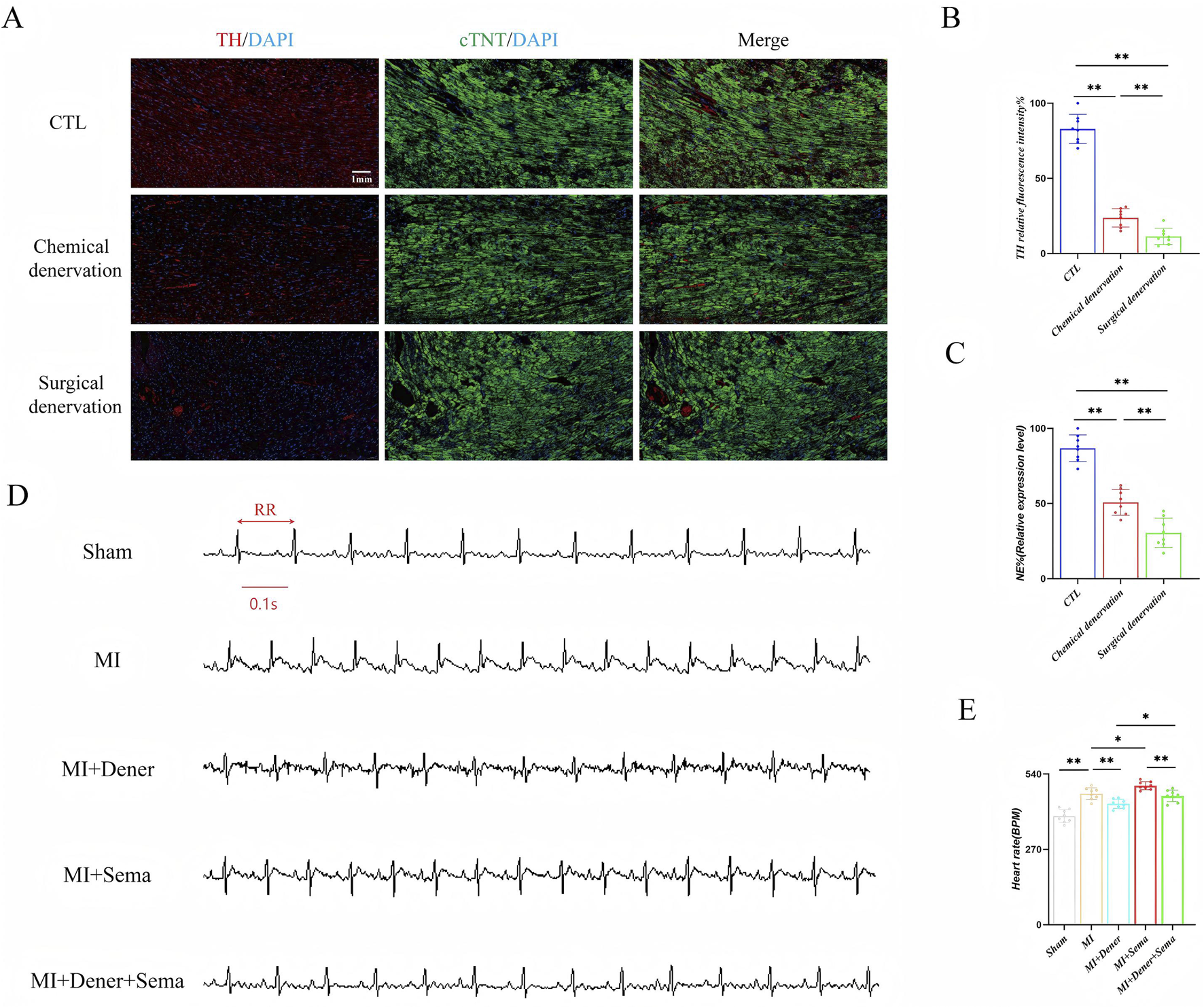 A multi-panel figure illustrates the effects of chemical and surgical denervation on cardiac tissue and heart function. Panel A shows fluorescent images of cardiac tissue stained with TH/DAPI and cTNT/DAPI markers, highlighting differences between the control (CTL), chemical denervation, and surgical denervation groups. Panels B and C present bar graphs comparing TH and Nerve Growth Factor (NGF) expression levels, respectively, with significant differences indicated. Panel D displays electrocardiogram (ECG) traces from different treatment groups, namely Sham, Myocardial Infarction (MI), MI with Denervation (MI+Dener), MI with Semaphorin (MI+Sema), and MI with combined Denervation and Semaphorin (MI+Dener+Sema). Panel E shows a bar graph of heart rate measurements across different groups, indicating statistical significance with asterisks.