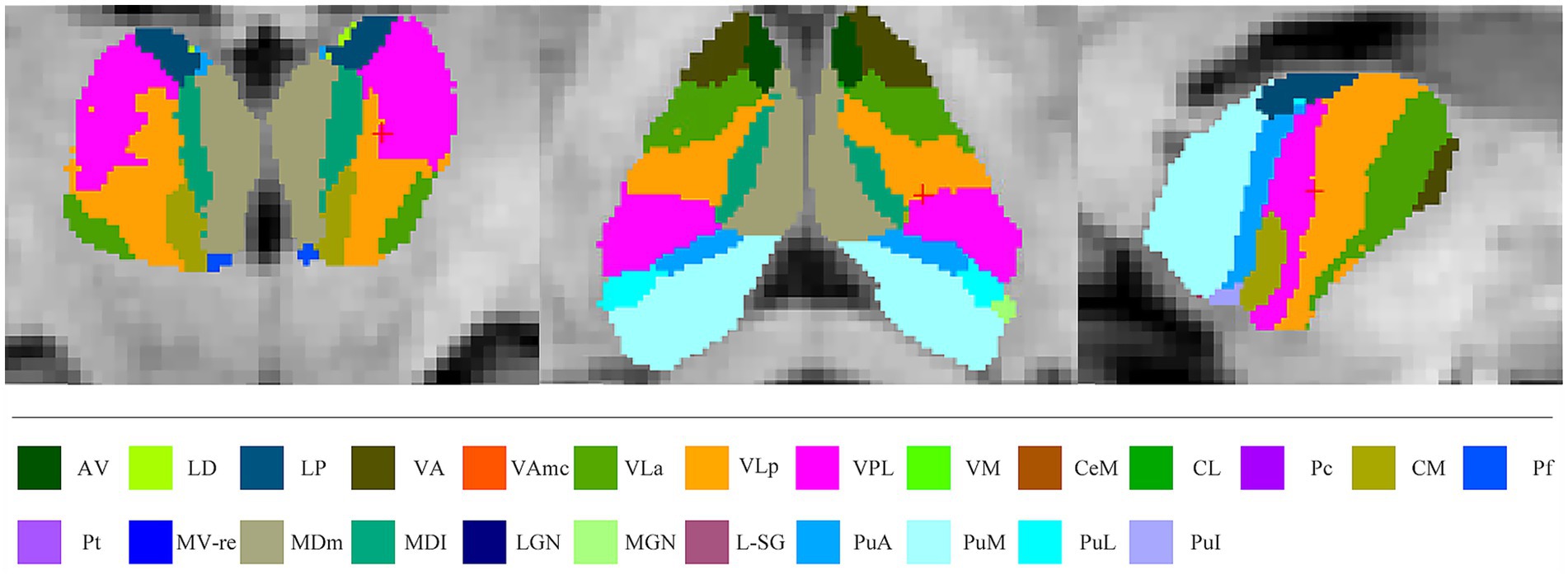 MRI brain scan displaying segmented regions in various colors, each labeled with an abbreviation. A legend below identifies the regions with corresponding colors and codes like AV, LD, LP, and others for easy reference. The focus is on anatomical differentiation.
