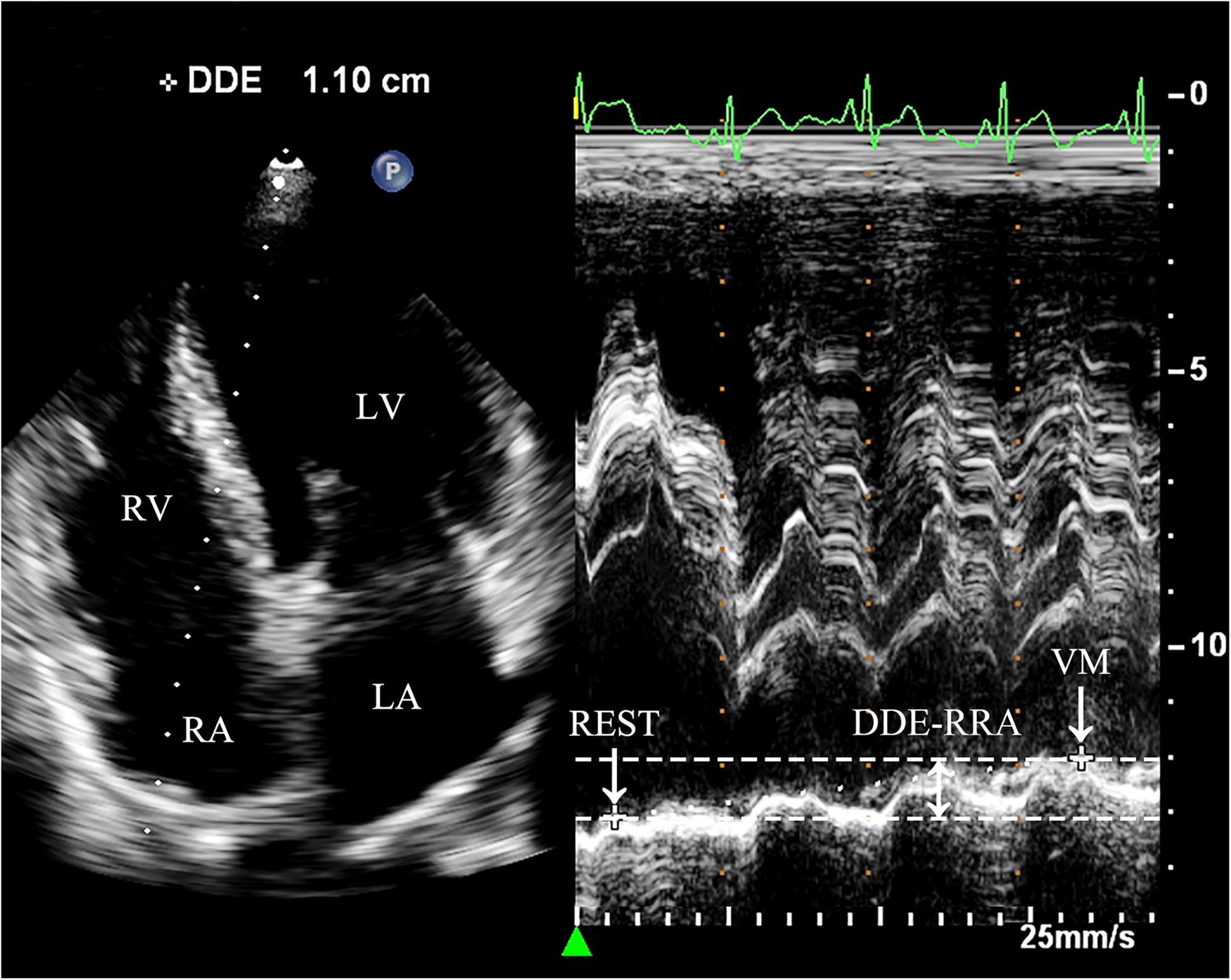 Ultrasound image showing a heart with labeled chambers: right atrium (RA), right ventricle (RV), left atrium (LA), and left ventricle (LV). Measurement marked DDE is 1.10 centimeters. The right side displays a graph with peaks and markings labeled REST, DDE-RRA, and VM, referencing velocity measurements. The graph indicates time at twenty-five millimeters per second.