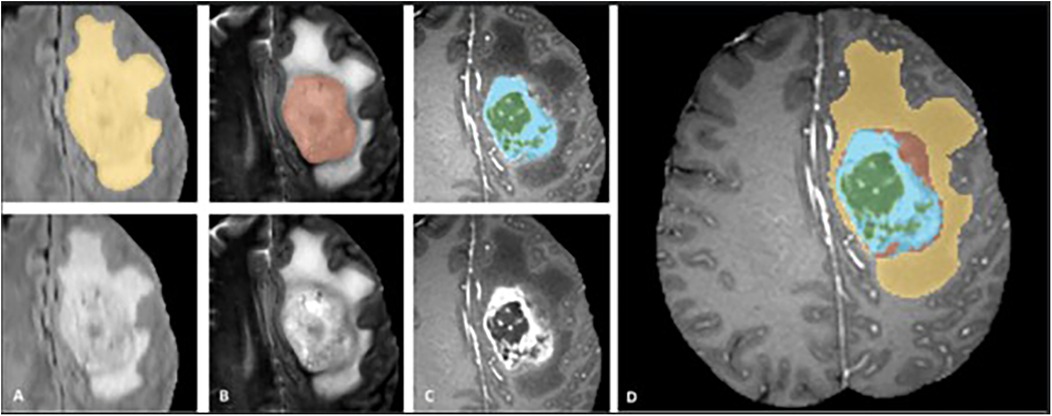 MRI scans of a brain tumor in four panels labeled A to D. Each panel highlights different areas with color overlays: yellow, red, blue, and green. Panel D shows a larger view with all colors combined, indicating areas of interest within the brain.