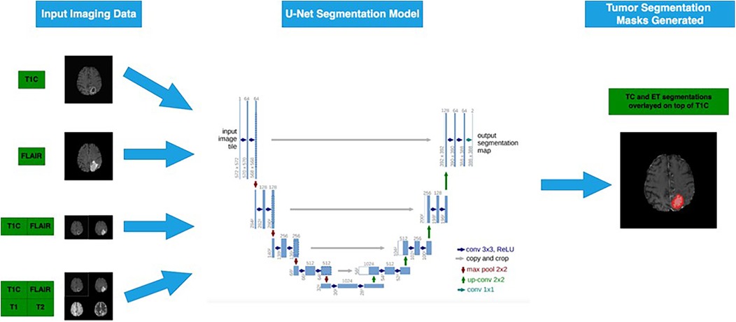 Flowchart illustrating a U-Net segmentation model for tumor detection. Input imaging data includes T1C and FLAIR MRI scans. These are processed through the U-Net model to generate segmentation masks. The output shows tumor segmentations overlaid on the original T1C image.
