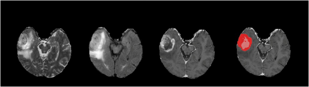 Four sequential MRI brain scans show a progression. The first three scans display a bright lesion on the left side. The fourth scan highlights this lesion in red, indicating its location.
