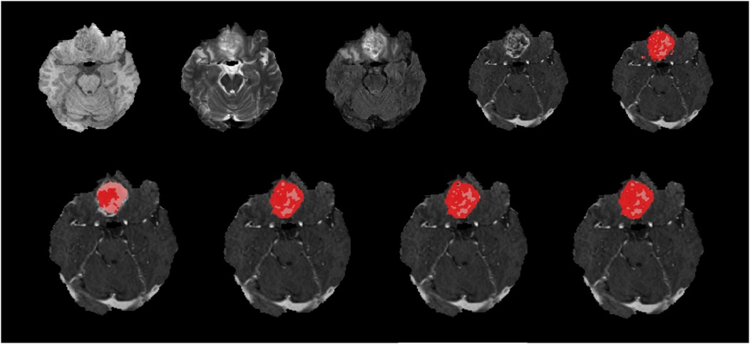 Ten brain MRI scans in two rows, depicting progressive changes. The top row shows grayscale images. The bottom row highlights areas in red on the grayscale, indicating regions of interest.