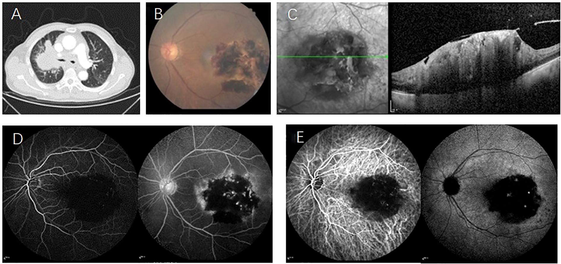 Composite images showing multiple medical scans: A) Chest CT shows central lung cancer in the right upper lobe. B) Fundus exam reveals large yellow-white lesions in the left macula and temporal retina. C) OCT displays retinal protrusion with full-thickness necrosis. D) FA demonstrates hypoflurescence with punctate hyperflurescence and late leakage. E) ICGA shows persistent hepoflurescence and dilated retinal vessels.