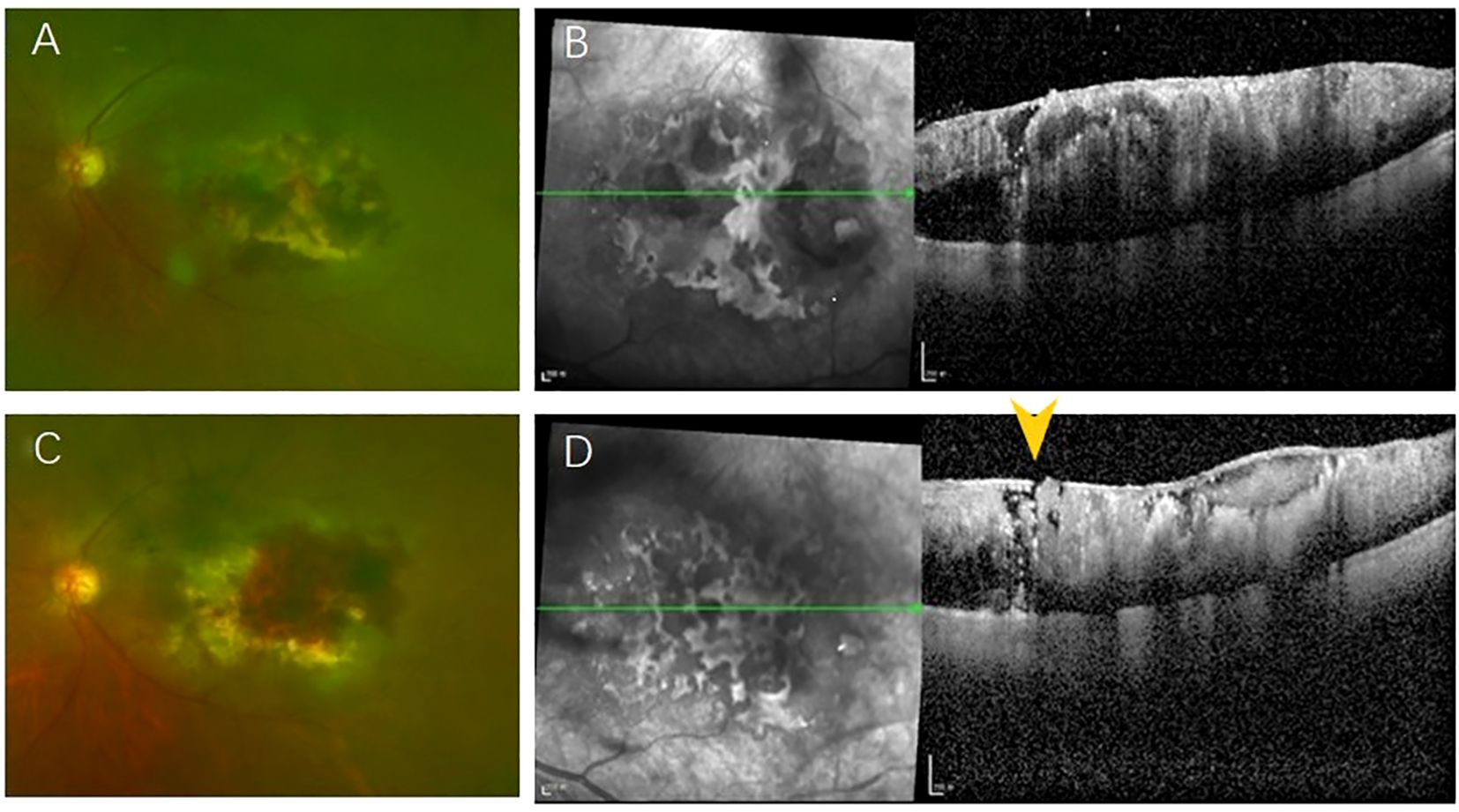 Four-panel medical image showing retinal scans. Panel A and C are fundus photos show enlarging lesion with increased hemorrhage. Panel B and D reveals tumor growth, ILM rupture (arrow), and retinal collapse.
