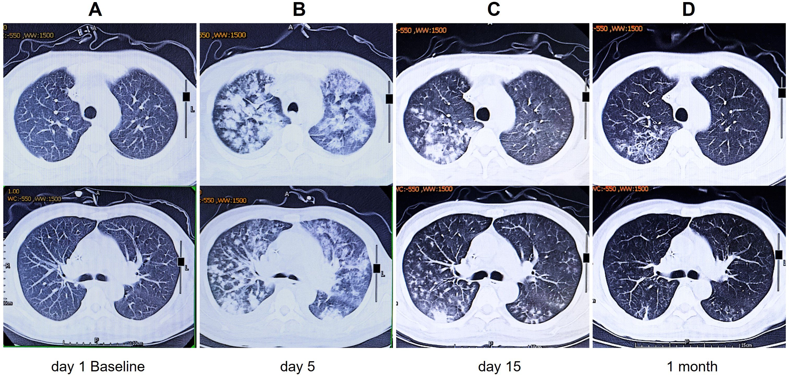 CT scans showing the progression of lung condition over time. Panels A to D represent scans at day 1 (baseline), day 5, day 15, and 1 month, respectively. Panel A shows relatively clear lungs, while Panel B shows increased opacity, indicating worsening. Panel C shows partial improvement, and Panel D shows significant clearing after 1 month.