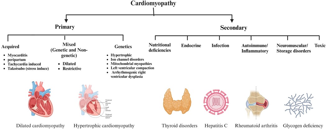 Flowchart detailing causes of cardiomyopathy, divided into primary and secondary. Primary causes include acquired, mixed (genetic and non-genetic), and genetic factors, such as myocarditis and hypertrophic conditions. Secondary causes are nutritional deficiencies, endocrine issues like thyroid disorders, infections such as hepatitis C, autoimmune/inflammatory diseases like rheumatoid arthritis, neuromuscular/storage disorders, and toxic factors, including glycogen deficiency. Illustrations depict conditions like dilated and hypertrophic cardiomyopathy, thyroid disorders, hepatitis C, rheumatoid arthritis, and glycogen deficiency.