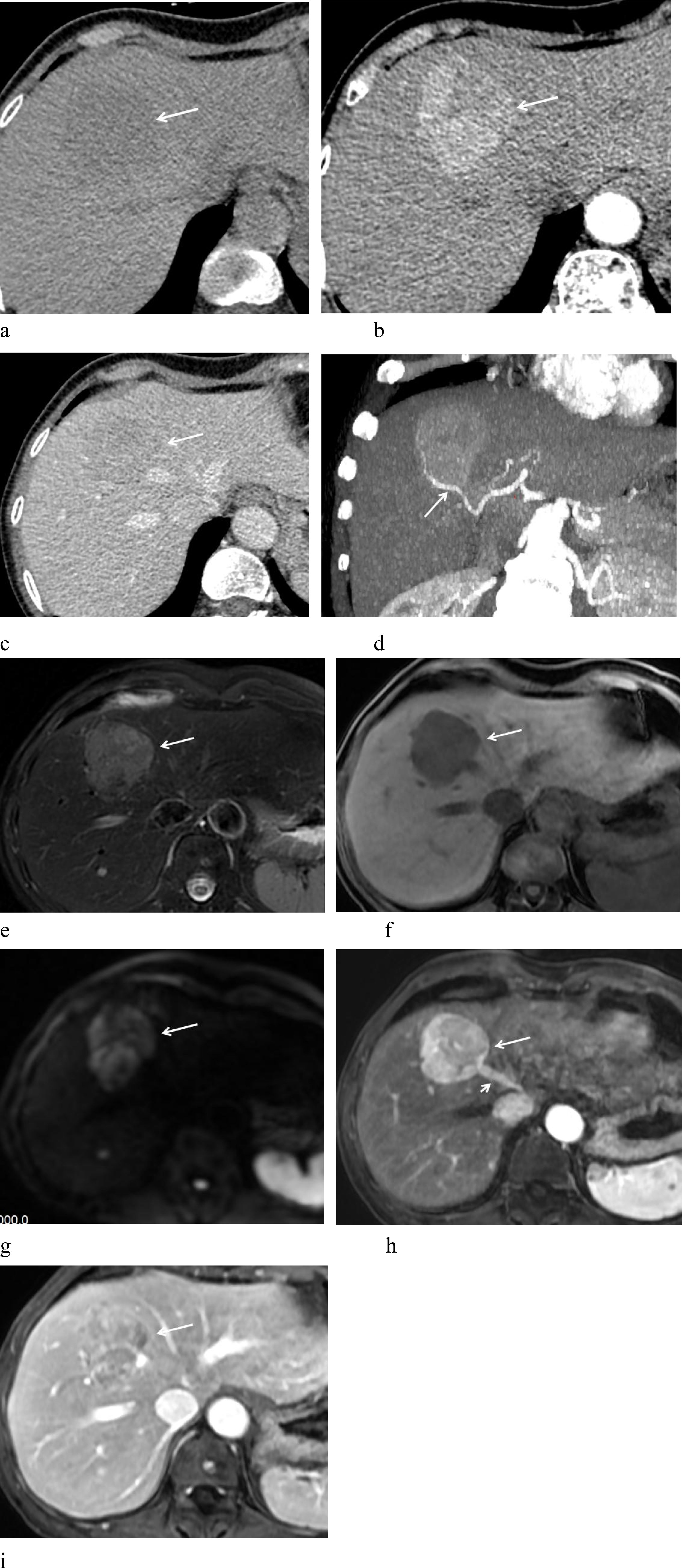 CT and MRI scans of the liver showing various lesions highlighted by arrows. Images a to d represent different angles and phases in CT scans, while images e to i display MRI results under various sequences, emphasizing the presence and characteristics of liver lesions.