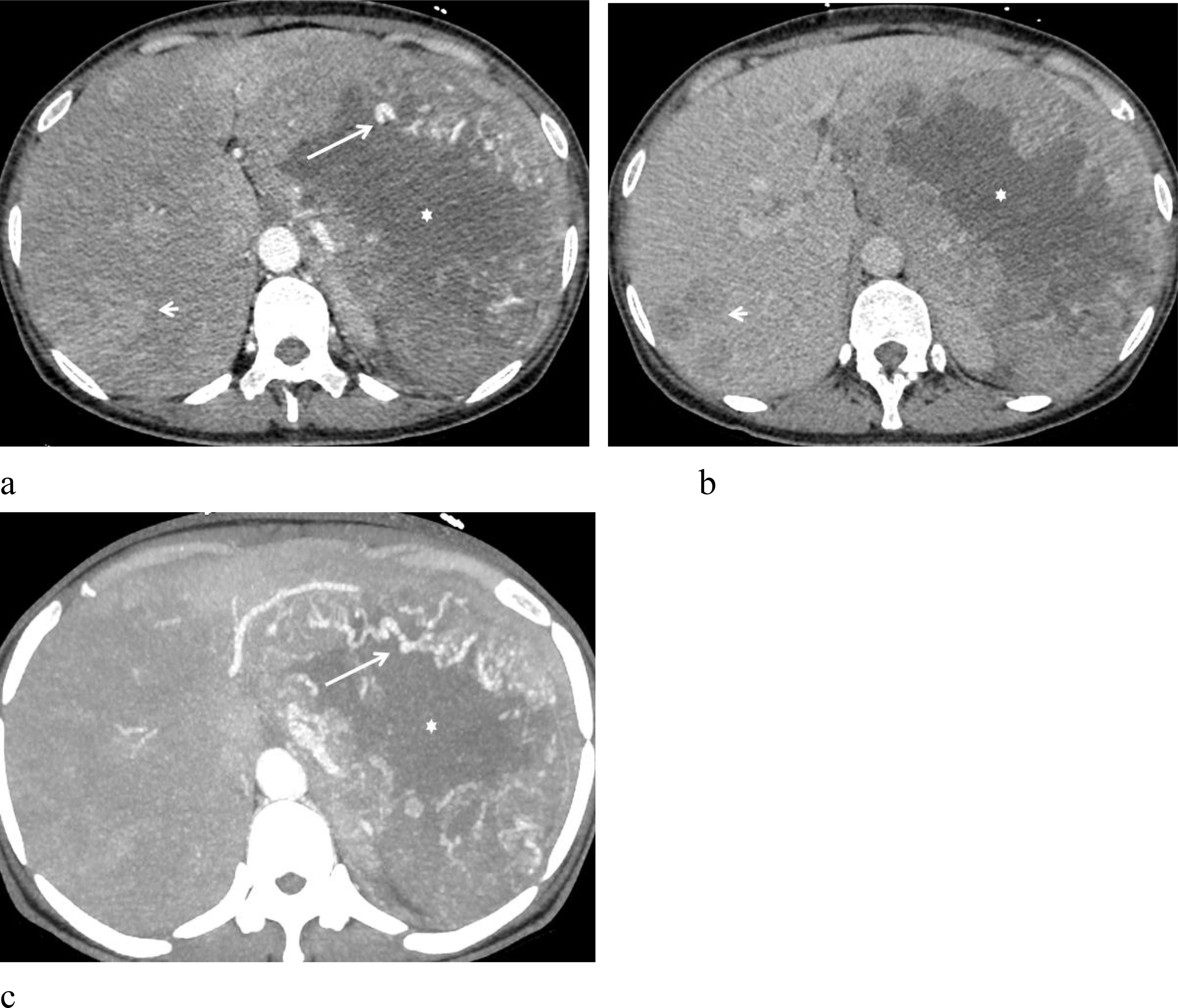 CT scans of the liver in three panels labeled a, b, and c. Panel a displays an arrow pointing to a distinct area in the liver, marked by a star and a small arrowhead. Panel b shows the liver featuring a star and an arrowhead without any arrows. Panel c illustrates another portion of the liver with an arrow indicating a specific area, marked by a star.