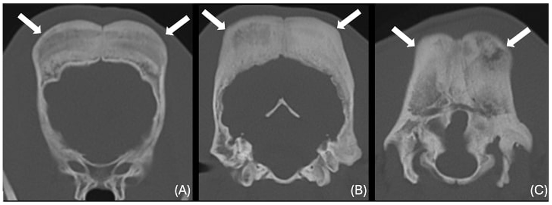 Three-panel CT scan images of a skull. Panel A shows thick dense line, indicated by arrows. Panel B displays a skull with a slightly irregular density in the same region. Panel C shows significant thinning and irregularity in the skull’s structure, as highlighted by arrows.