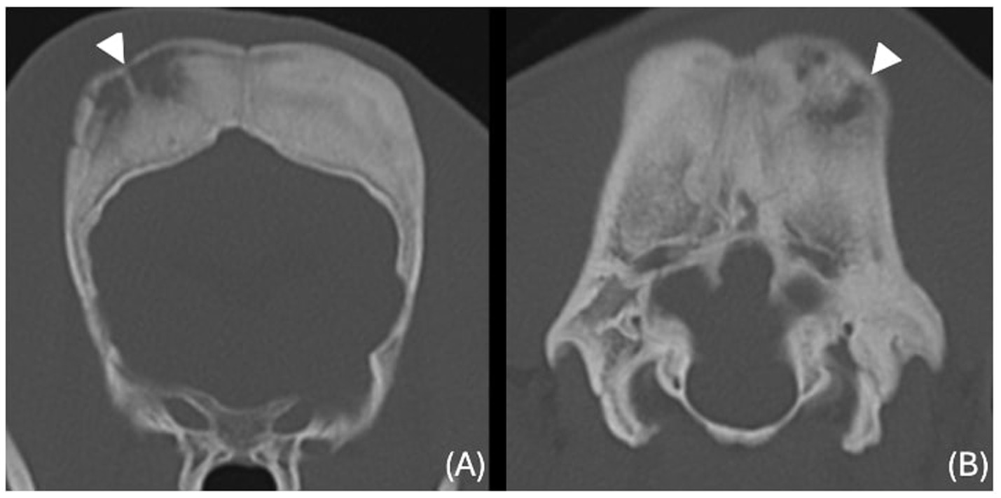 Two CT scan images of a skull. Image A shows the skull in a coronal view, with a fracture indicated by a white arrowhead. Image B presents an axial view of the skull, also highlighting a bone lysis with a white arrowhead.