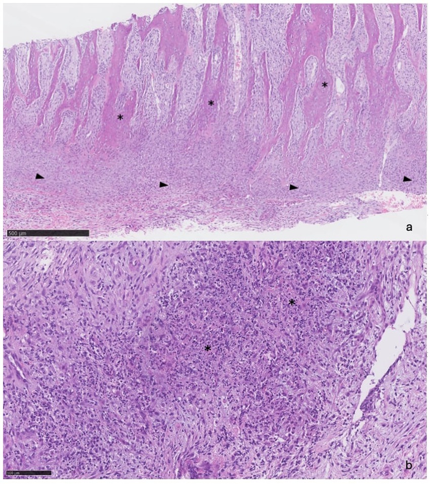 Histological sections of abnormal canine skull bone. Image (A) (10x magnification): Trabeculae of reactive bone (marked with asterisks) are interspersed with bundles of fibroblasts and an expanded periosteum (indicated by arrowheads). Image (B) (20x magnification): Areas of bone necrosis (asterisks) are visible. Both images stained with hematoxylin and eosin (H&E).
