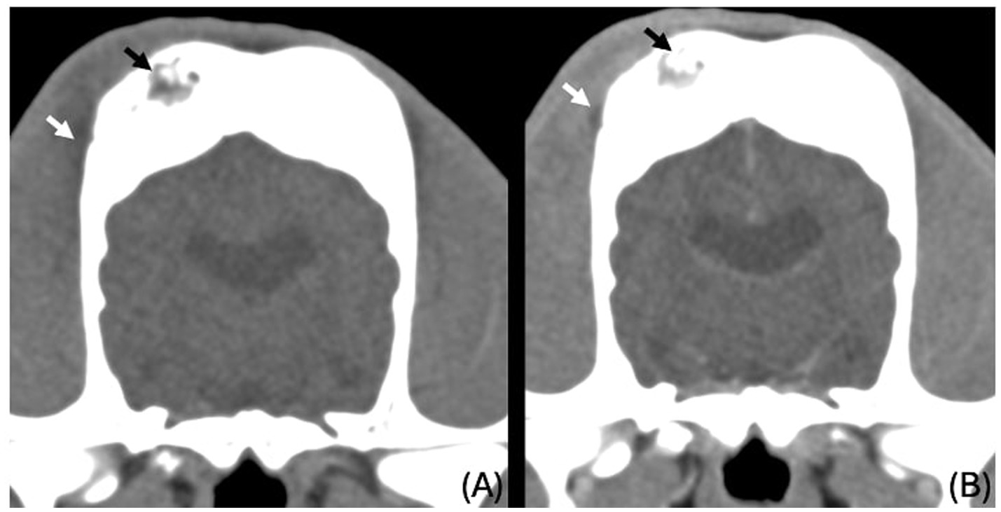 Transverse CT images of the parietal bones. Image (A): Unenhanced scan showing areas of bone lysis filled with fluid to soft tissue attenuating material (black arrows). Image (B): Post-contrast venous phase scan showing the same lytic areas (black arrows), along with ill-defined, hypoattenuating, contrast-enhancing changes in the right temporal muscle (white arrows).