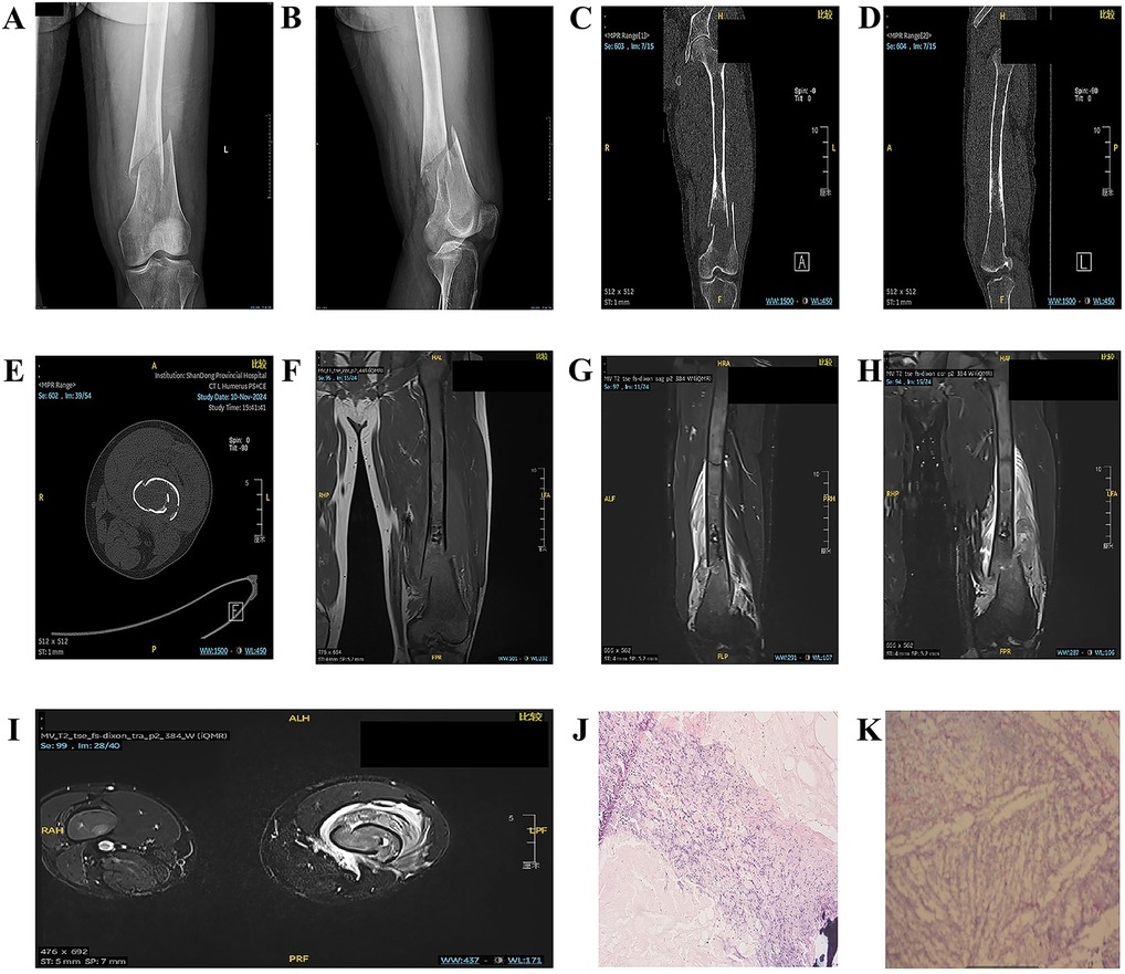 健康・医学 Occlusion Shockwave IVL Below The Knee - Shockwave Medical