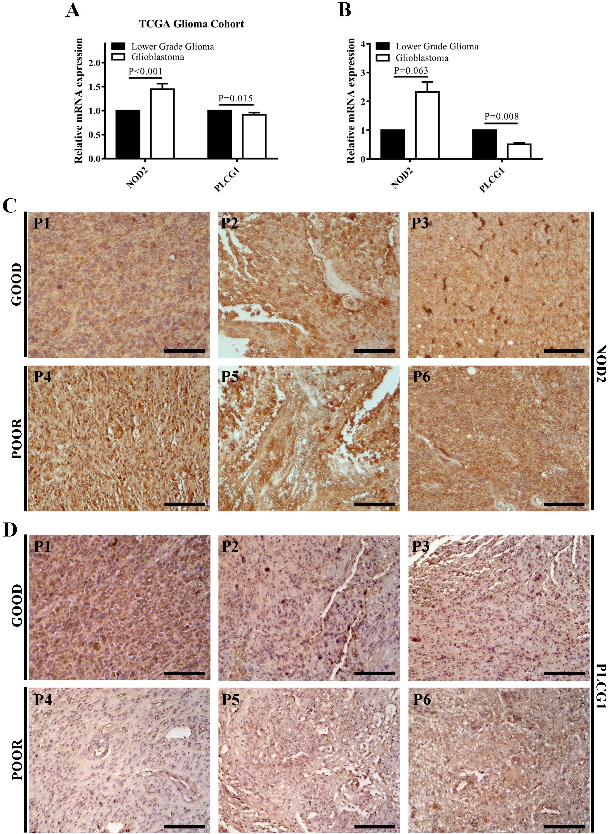 Bar graphs and microscopic images illustrate NOD2 and PLCG1 expression in glioma studies. Graphs A and B compare mRNA expression in lower grade glioma and glioblastoma with significant p-values noted. Panels C and D display histological samples showing varying expression of NOD2 and PLCG1 under conditions marked as “GOOD” and “POOR,” labelled from P1 to P6 with scale bars for reference.
