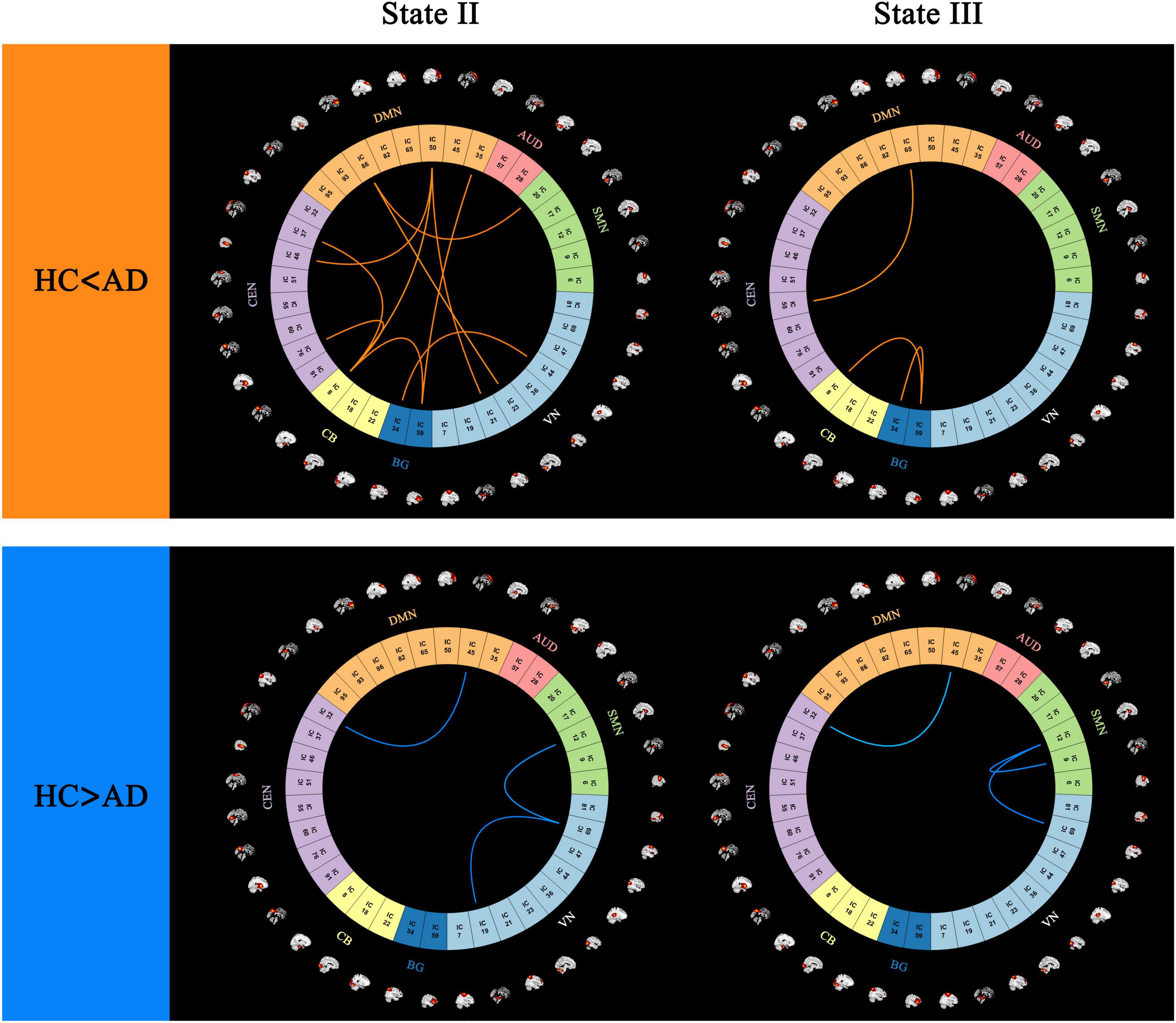 Four circular diagrams depict brain connectivity in two states (II and III), showing differences between healthy controls (HC) and Alzheimer’s patients (AD). The top diagrams highlight orange connections where HC is less than AD. The bottom diagrams show blue connections where HC is greater than AD. Sections labeled DMN, AUD, SMN, VN, BG, CB, and CEN are arranged in a circle with small brain images surrounding them.