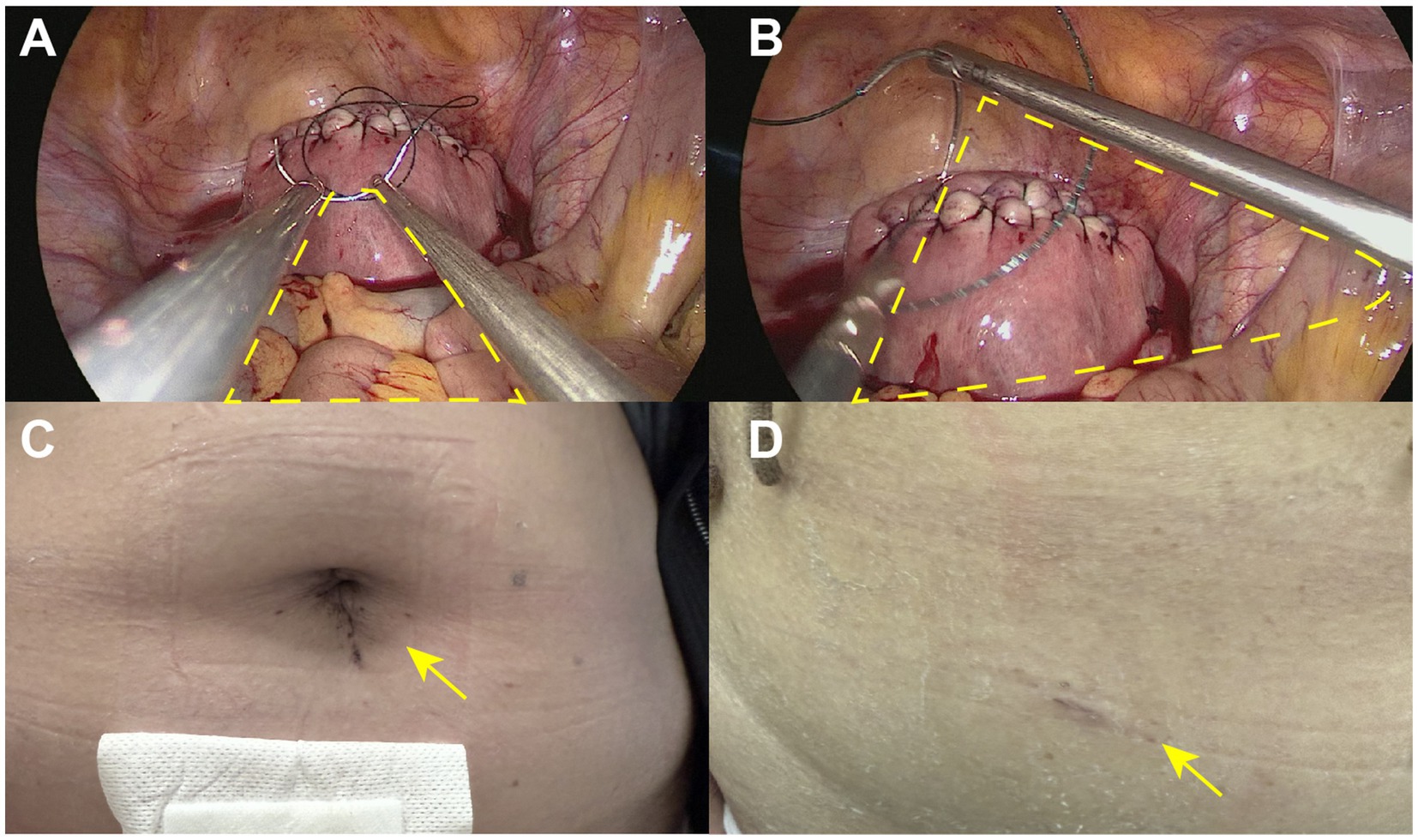 A composite image with two parts. Panel A shows a surgical procedure with tools and stitches on an internal organ, highlighted by yellow dashed lines. Panel B presents a closer view of the same area. Panel C depicts a post-surgical abdomen showing a small incision near the navel with a yellow arrow. Panel D shows a healed incision scar on an abdomen, also indicated by a yellow arrow.
