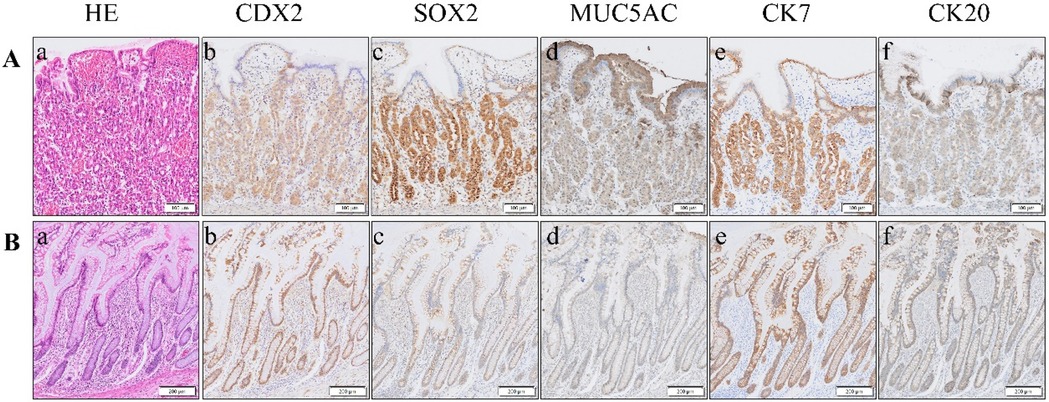 Histological and immunohistochemical images showing tissue samples labeled with various markers. Row A displays HE, CDX2, SOX2, MUC5AC, CK7, and CK20 staining at 100 micrometers scale. Row B shows the same markers at 200 micrometers scale. Sections are detailed with different staining patterns, indicating expression levels across tissues.