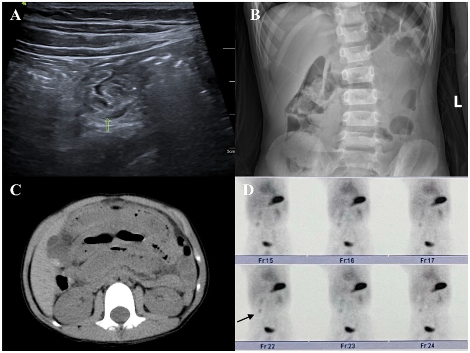 Ultrasound image labeled A showing intussusception with a target sign. X-ray image labeled B displaying the abdomen with visible bowel loops. CT scan image labeled C showing an axial view of the abdomen. Series of PET scan images labeled D showing front section views with areas of uptake indicated by black spots.