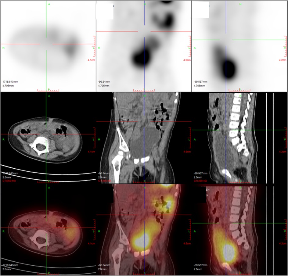 Medical imaging panel showing PET and CT scans in axial, coronal, and sagittal views. The top row contains PET scans with varying levels of color intensity indicating metabolic activity. The bottom row features corresponding CT scans and combined PET-CT overlays, highlighting areas of interest with increased metabolic activity, shown in bright colors. The images are annotated with crosshair markers and measurement scales.