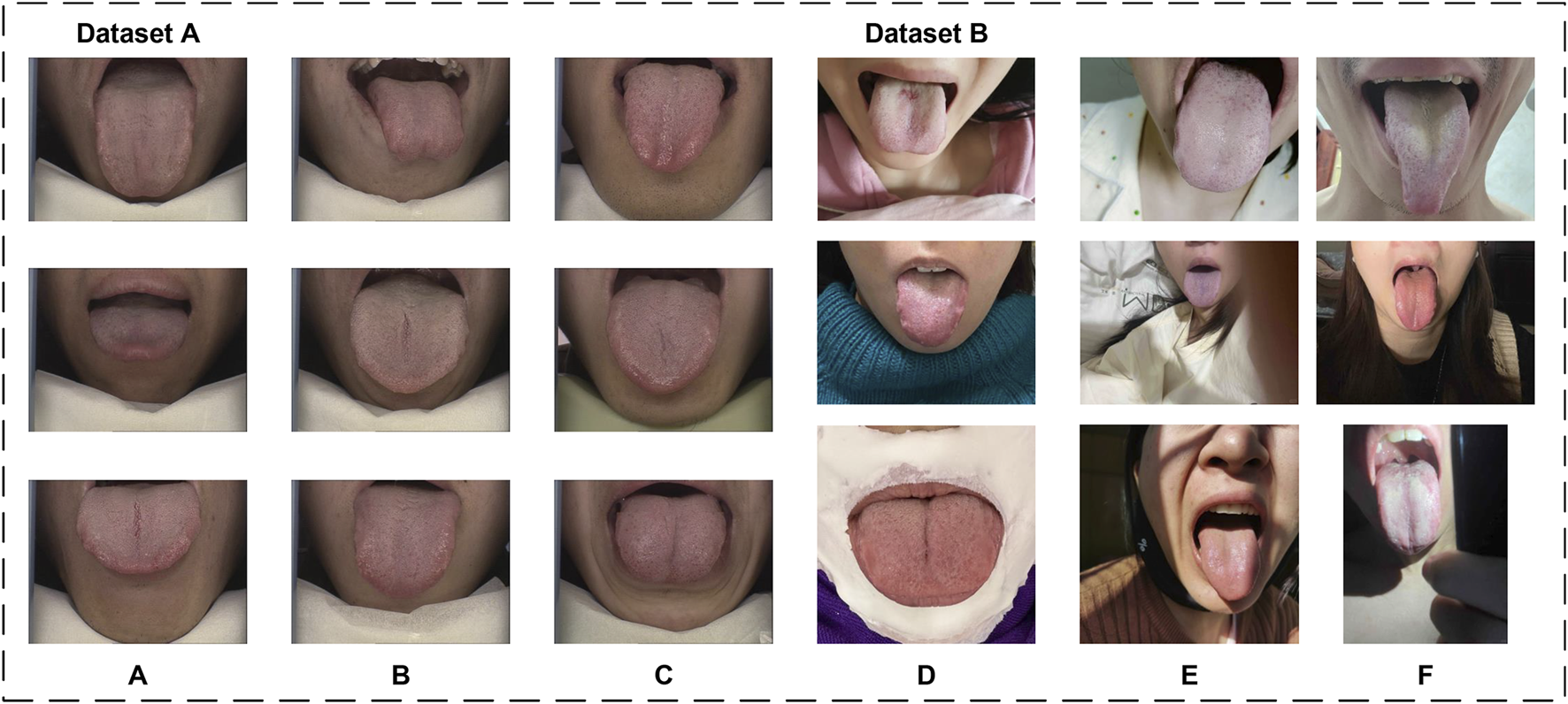 Two datasets, A and B, show multiple photographs of tongues. Dataset A includes standardized images of tongues from different angles, some with a coating and variations in texture. Dataset B features more casual images displaying tongues with various colors, textures, and lighting conditions.