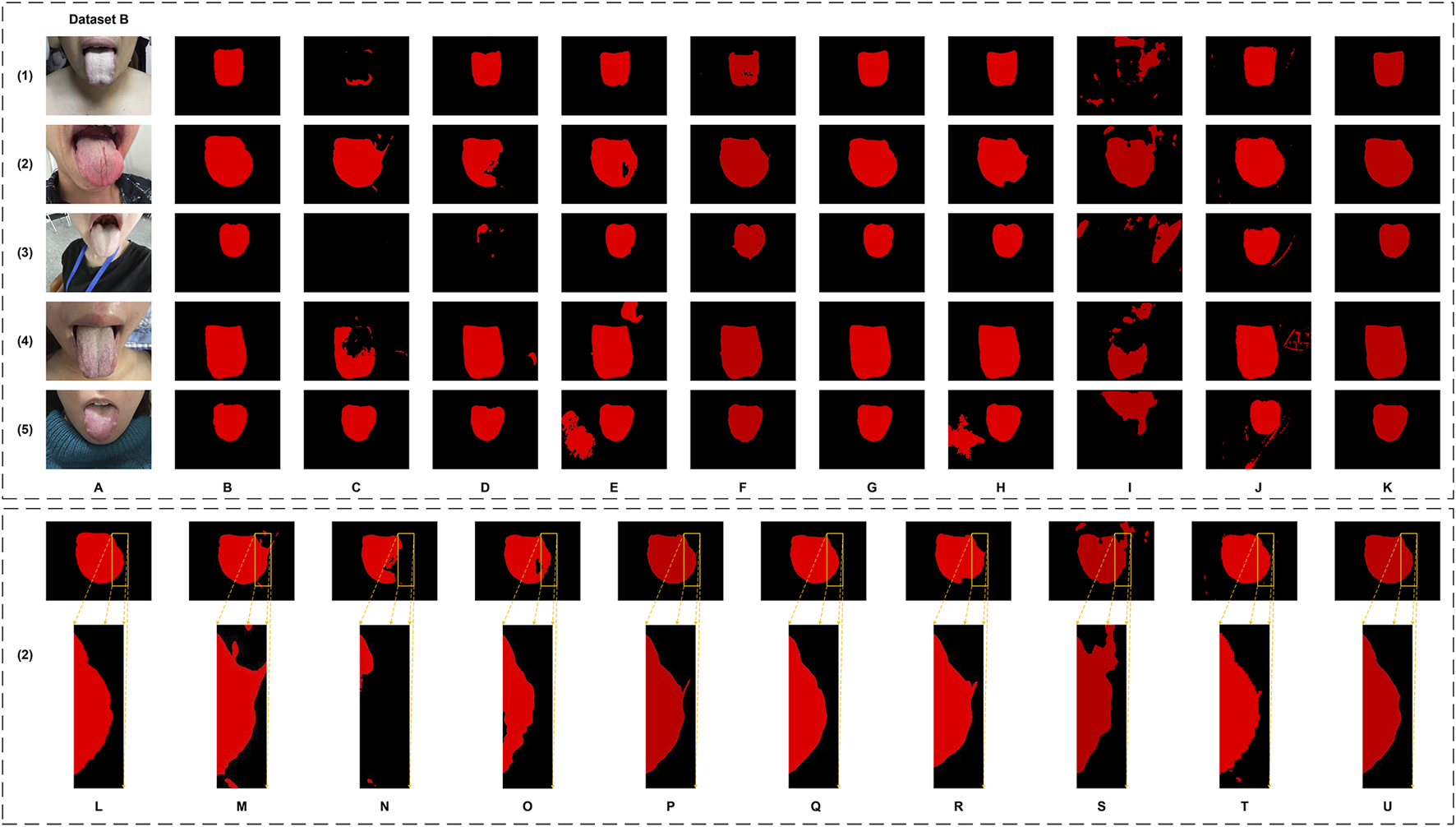 Medical images showing a series of tongue appearances in Dataset B, with five photographs of tongues in column (1) to (5) and corresponding analyzed contours in columns A to K. The bottom section expands analysis L to U, detailing specific areas with red contour lines on black backgrounds.