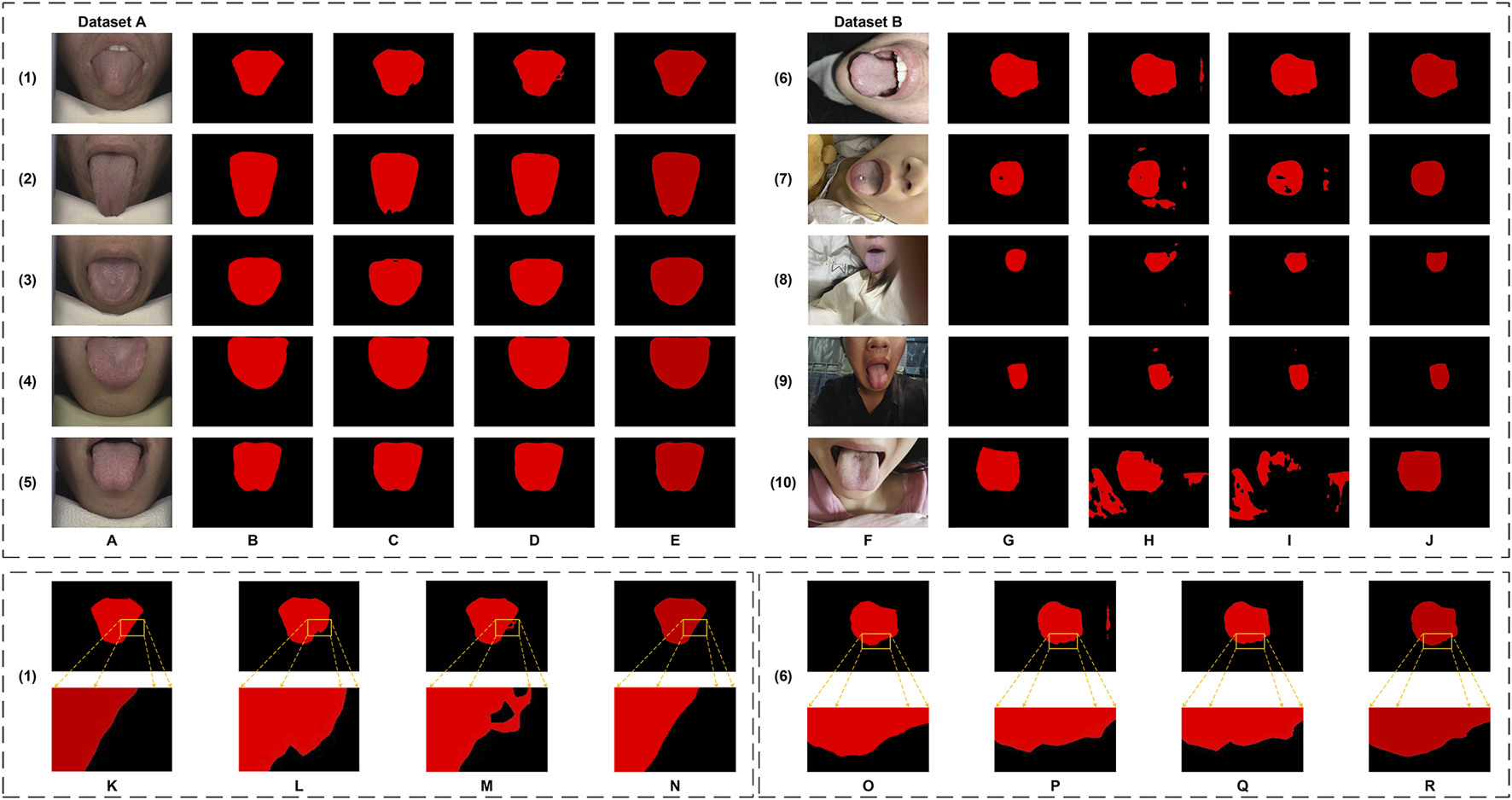 Comparison of tongue images from two datasets, A and B. Dataset A (images 1-5) shows tongues with edge detection outlines in red. Dataset B (images 6-10) shows similar tongue images with varied outlines. Enlarged sections (K-R) highlight specific edge details, focusing on texture differences in datasets.