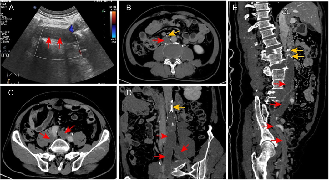 A series of medical images showing various scans. Panel A depicts an ultrasound with red arrows indicating a specific area. Panels B and C are axial CT scans with red and yellow arrows pointing to particular regions. Panel D is a coronal CT scan with red and yellow arrows highlighting areas of interest. Panel E is a sagittal CT scan, again with red and yellow arrows marking specific points.