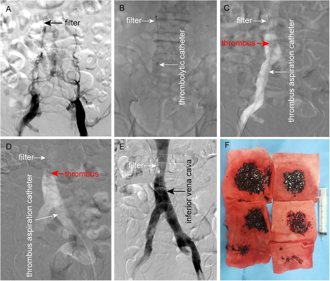 Five medical imaging panels (A-E) showing a filter, thrombolytic catheter, thrombus aspiration catheter, and inferior vena cava. Thrombuses are highlighted in red in panels C and D. Panel F displays extracted thrombuses on red gauze alongside a syringe.