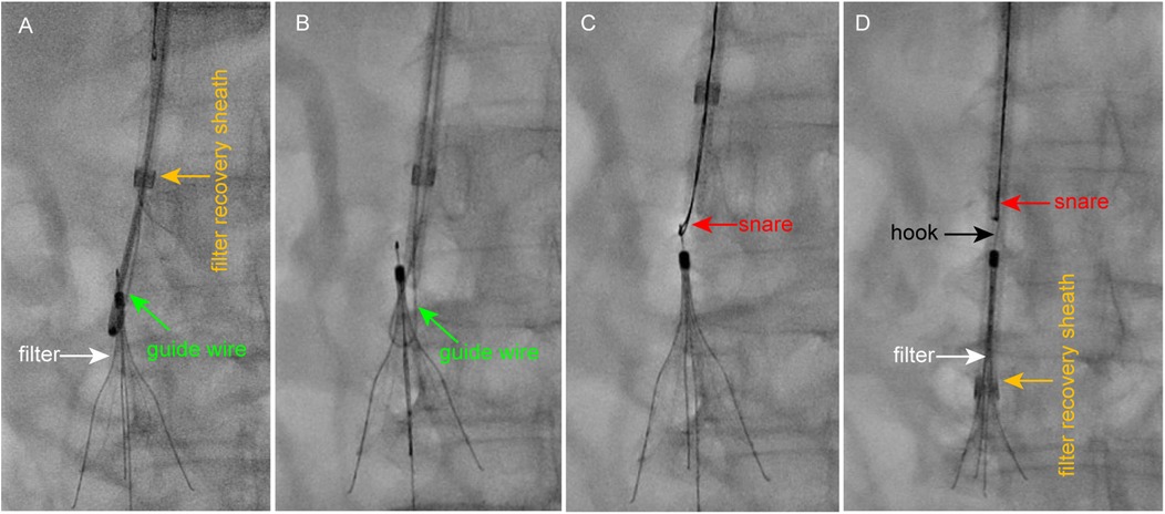 Fluoroscopic images labeled A to D showing the progression of an endovascular procedure. Panel A shows a filter with a guide wire and recovery sheath inserted. Panel B shows a guide wire in place. Panel C displays a snare capturing the filter. Panel D illustrates the hook, snare, and filter recovery sheath fully engaged with the filter.
