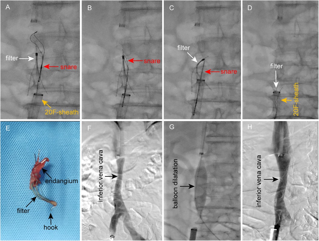 Series of eight panels showing medical imaging and a removed filter. Panels A to D display x-ray images of a filter snare technique in a vena cava, labeled with filter, snare, and 20F-sheath. Panel E shows a removed filter with an endangium and hook on a blue surface. Panels F to H display x-ray images of the interior vena cava and balloon dilatation, labeled with relevant annotations.