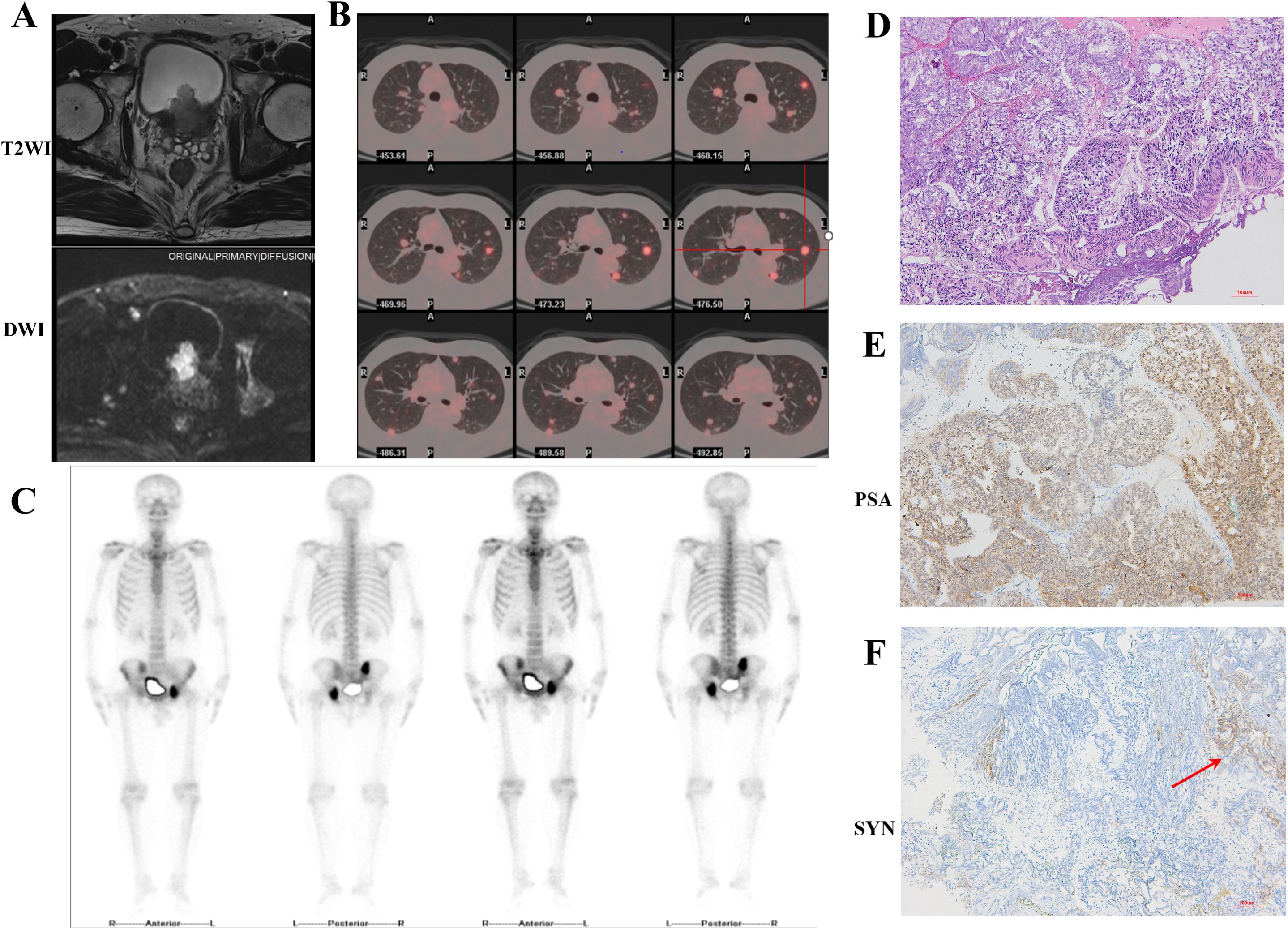 Composite medical images labeled A to F. A: MRI images showing T2-weighted imaging (T2WI) and diffusion-weighted imaging (DWI) of the pelvic region. B: Series of PET/CT scans displaying different cross-sections of the lungs with highlighted areas. C: Bone scintigraphy images of a skeletal system, focusing on pelvic regions. D: Histological section stained with hematoxylin and eosin shows tissue detail. E: Immunohistochemical staining with PSA marker identifies specific tissue regions. F: Immunohistochemical staining with SYN marker shows highlighted area with a red arrow pointing to a specific region.
