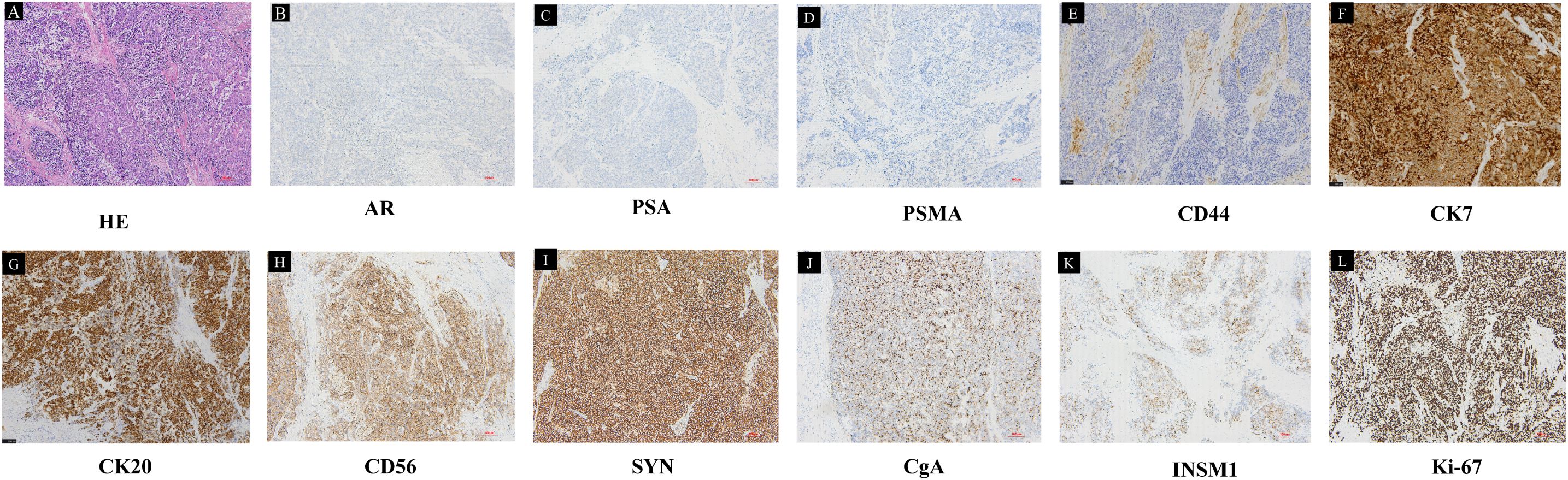 Histological slides show tissue samples with various staining. Panel A: Hematoxylin and Eosin (HE) staining. Panels B to L: Immunohistochemical staining for markers including AR, PSA, PSMA, CD44, CK7, CK20, CD56, SYN, CgA, INSM1, and Ki-67, highlighting different protein expressions within the tissue. Each panel depicts a unique pattern of staining intensity and distribution.