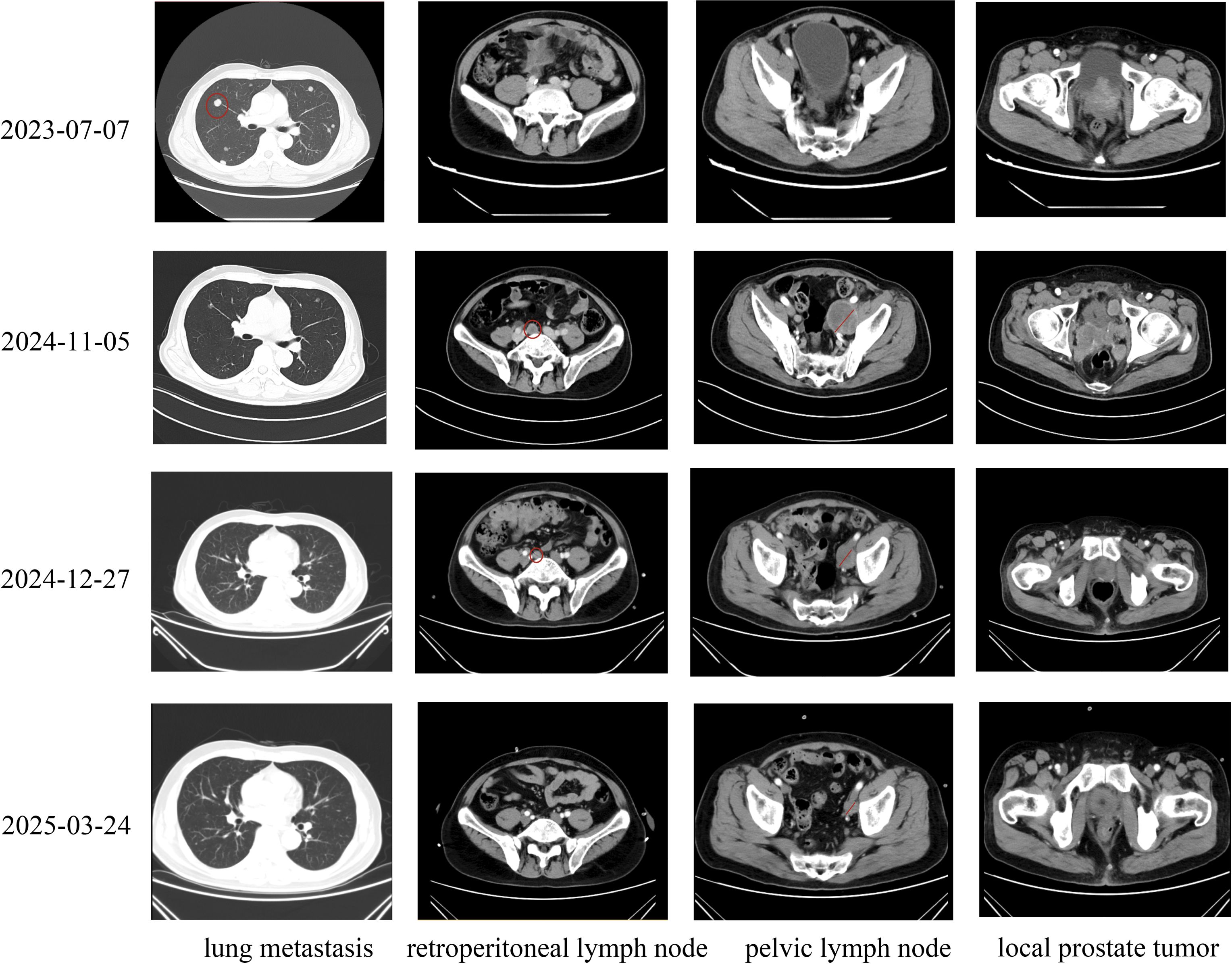 CT scans are displayed in a grid, showing progression over time. Rows correspond to dates: July 7, 2023; November 5, 2024; December 27, 2024; and March 24, 2025. Columns indicate specific areas: lung metastasis, retroperitoneal lymph node, pelvic lymph node, and local prostate tumor. Red circles highlight targeted regions.