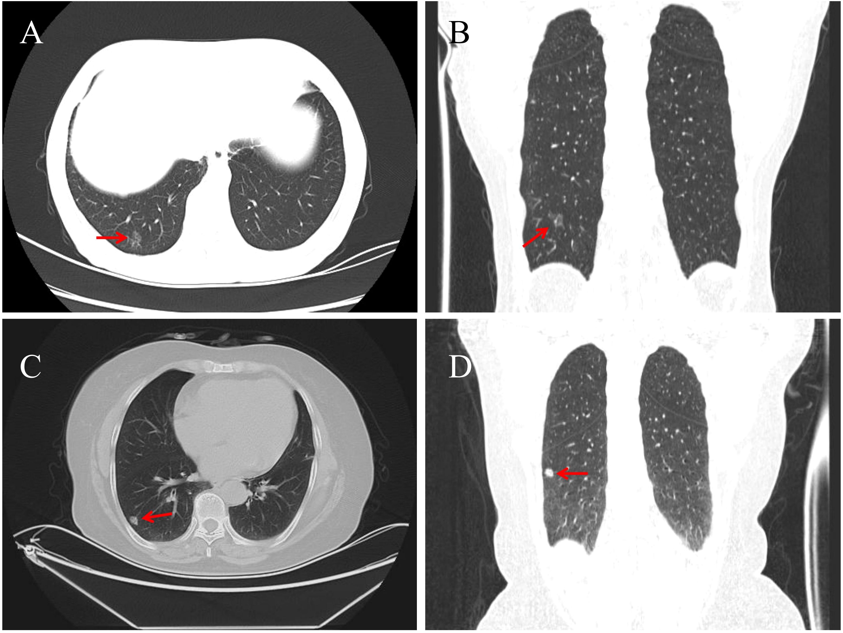 CT scan images showing lung sections with red arrows pointing to specific areas in each panel. Panel A and C are axial views; B and D are coronal views, indicating notable features in the lungs.